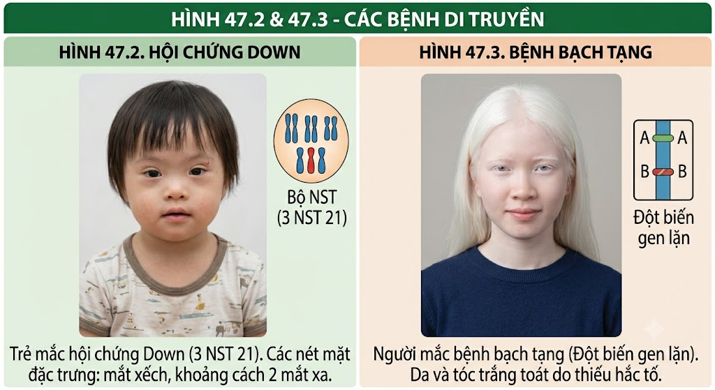 Hình 47.2 & 47.3 - Các bệnh di truyền